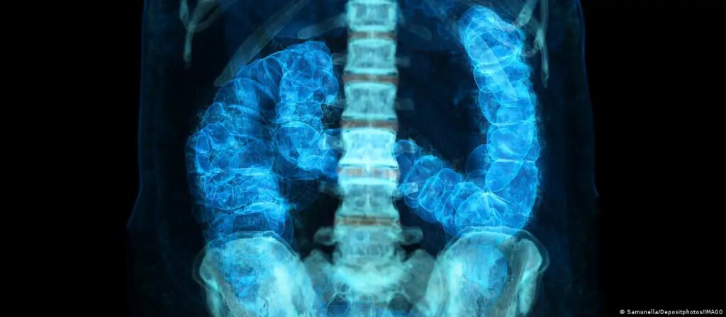 Câncer Colorretal: Fatores de Risco Crescentes entre Jovens e a Importância do Diagnóstico Precoce