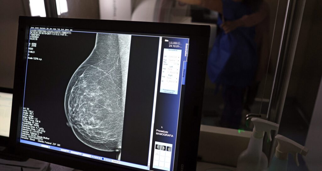 Como a IA Pode Prever Doenças Cardíacas em Mulheres Através de Mamografias