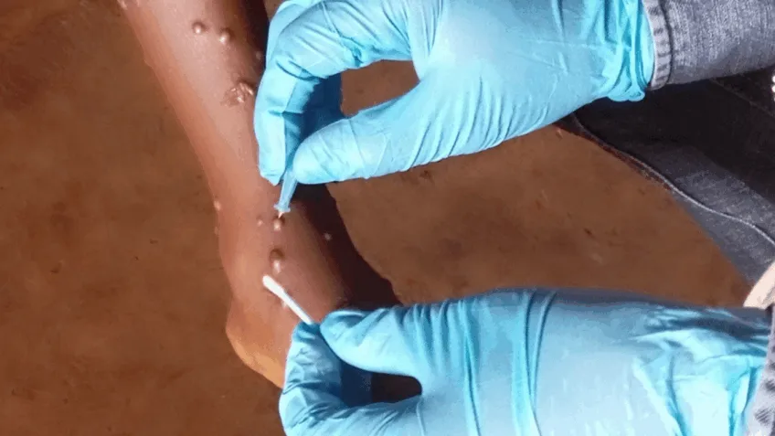 Minas Gerais Registra Dois Novos Casos de Mpox, Totalizando 17 Infecções Minas Gerais Registra Dois Novos Casos de Mpox, Totalizando 17 Infecções