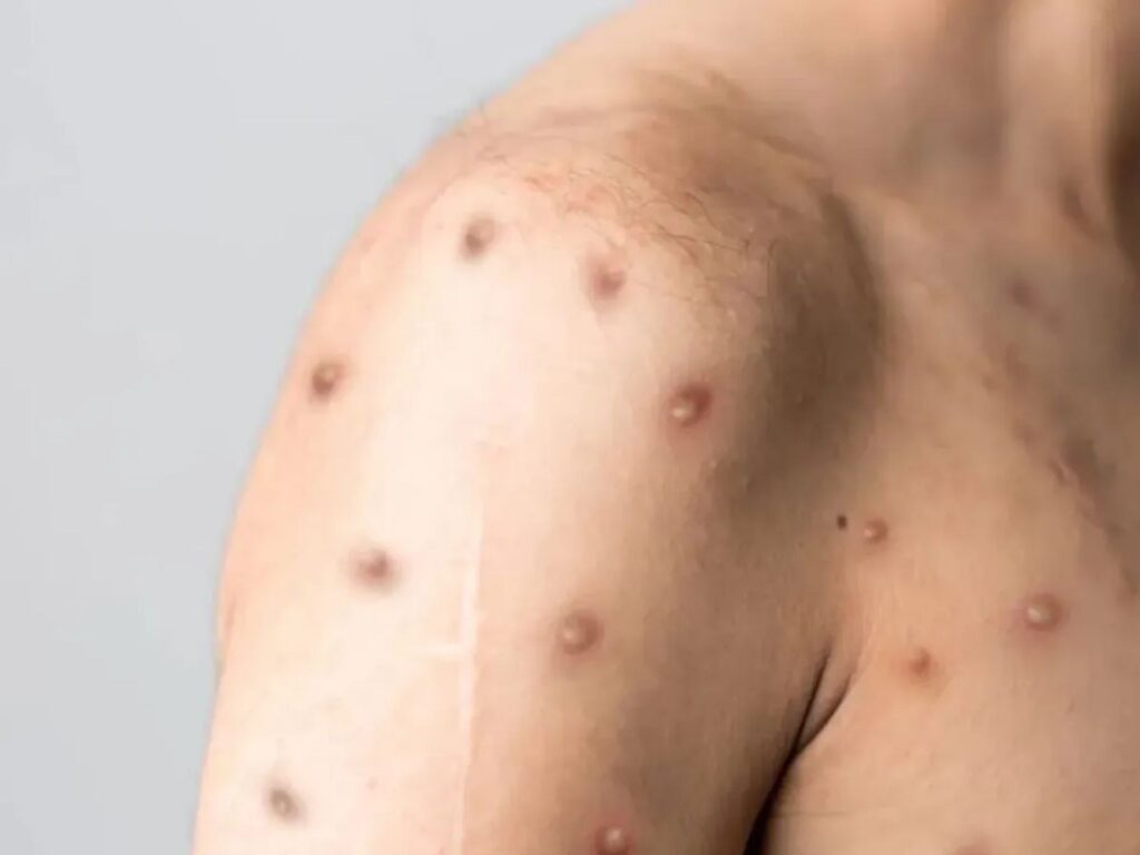 Mpox: Morte, Transmissão e Contato Íntimo – Especialistas Esclarecem Dúvidas Comuns