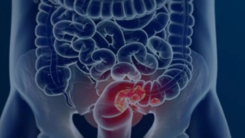 Exame Inovador Detecta Câncer Colorretal com 90% de Precisão